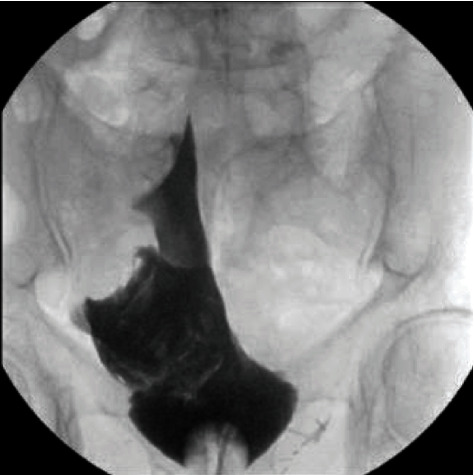 The Intraoperative Use of a Portable Cone-Beam Computed Tomography System for the Diagnosis of Intraperitoneal Bladder Perforation.