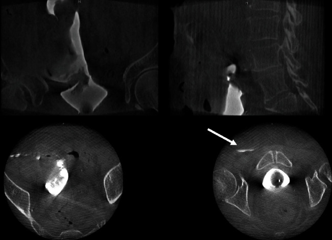 The Intraoperative Use of a Portable Cone-Beam Computed Tomography System for the Diagnosis of Intraperitoneal Bladder Perforation.