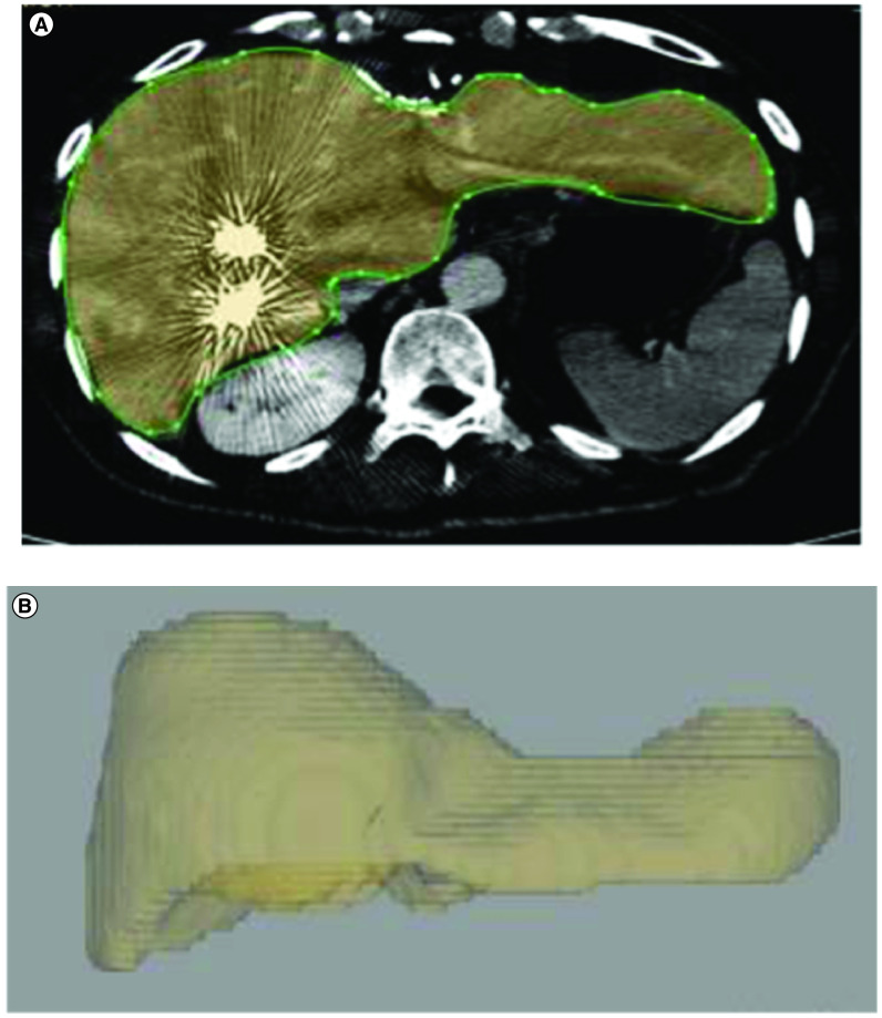 Portal vein embolization: rationale, techniques, outcomes and novel strategies.