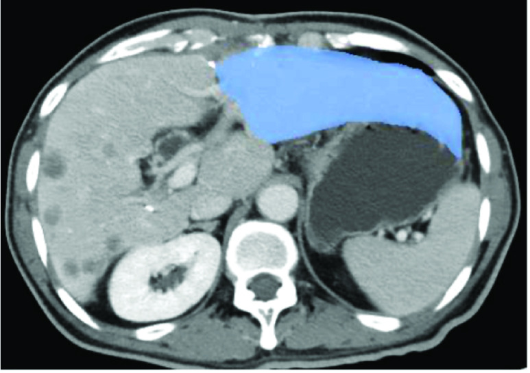 Portal vein embolization: rationale, techniques, outcomes and novel strategies.