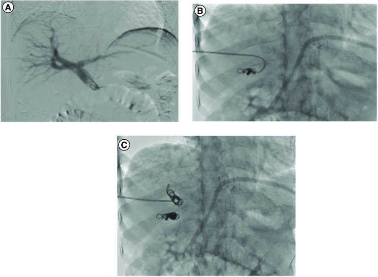 Portal vein embolization: rationale, techniques, outcomes and novel strategies.