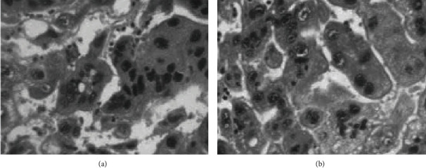 Primary Ovarian Choriocarcinoma: Rare Entity.