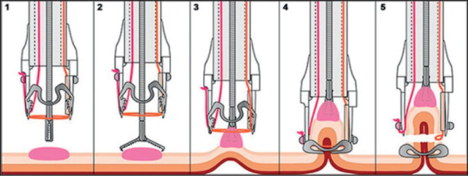 SINGLE CENTRE OUTCOMES OF ENDOSCOPIC FULL THICKNESS RESECTION (EFTR) OF COLORECTAL LESIONS USING THE FULL THICKNESS RESECTION DEVICE (FTRD).