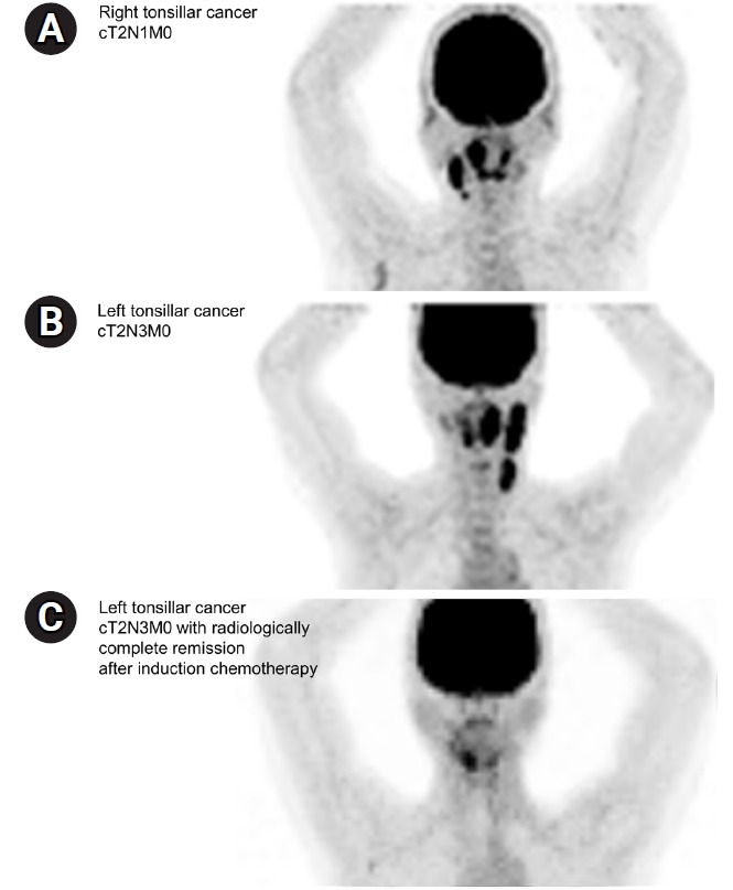 Survey of radiation field and dose in human papillomavirus-positive oropharyngeal cancer: is de-escalation actually applied in clinical practice?