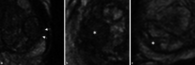 [PI-RADS 2.1 and structured reporting of magnetic resonance imaging of the prostate].