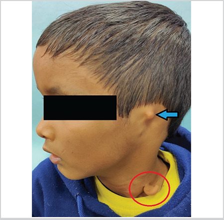 Where is my ear? - Cervical Chondrocutaneous Branchial Remnant.