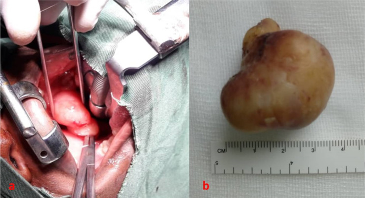 Solitary neurofibroma of the right lateral wall of the oropharynx.