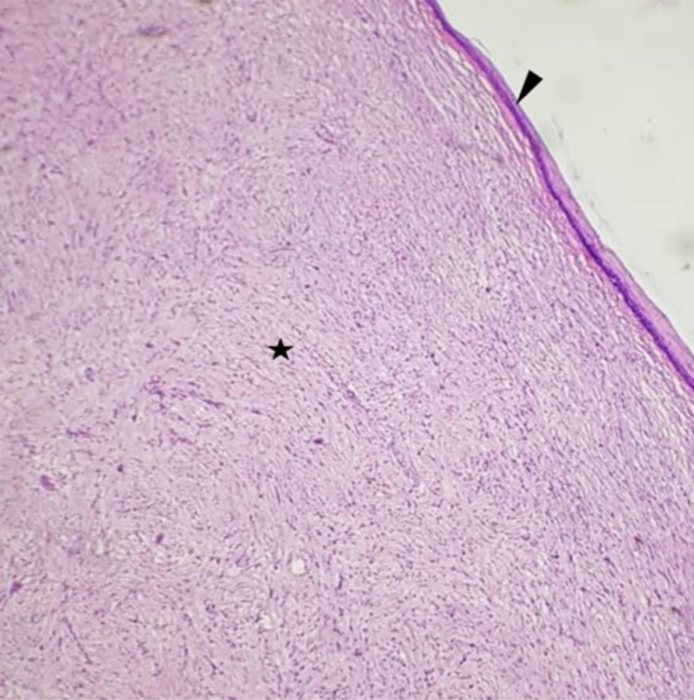 Solitary neurofibroma of the right lateral wall of the oropharynx.