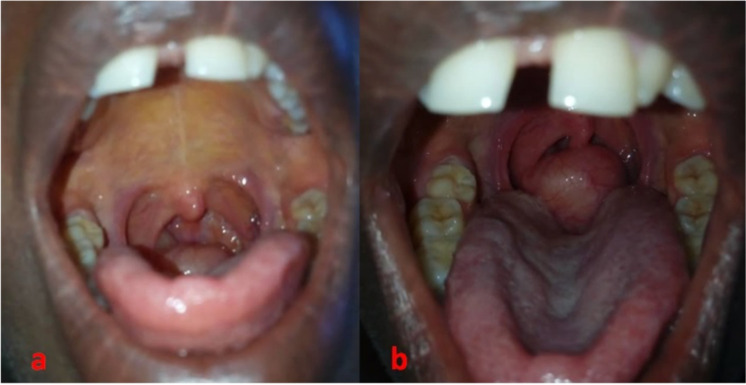 Solitary neurofibroma of the right lateral wall of the oropharynx.