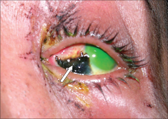 Ocular Complications Resulting from the Use of Traditional Herbal Medicine in Central Saudi Arabia: A Review.