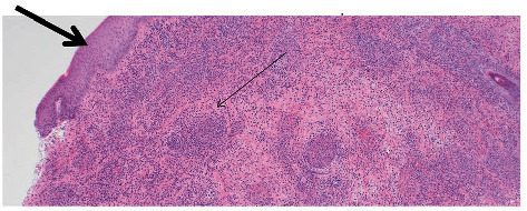 Undiagnosed Behçet's Disease Presenting as Fournier's Gangrene in a Young Male.