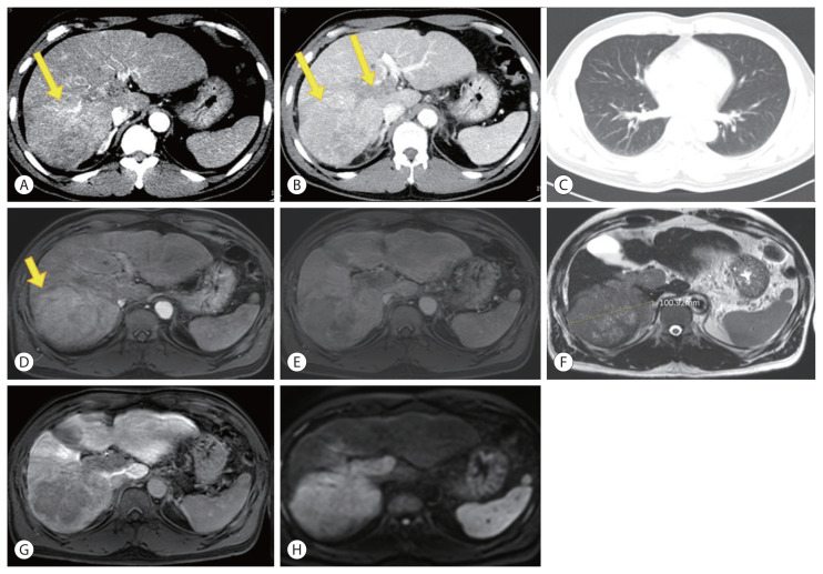 Infiltrative hepatocellular carcinoma with multiple lung metastasis completely cured using nivolumab: a case report.