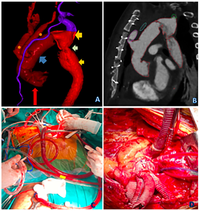 Acute Stanford type A aortic dissection associated with aortic coarctation repaired by Tirone E. David & debranching techniques with combined axillar and femoral perfusion: a case report.