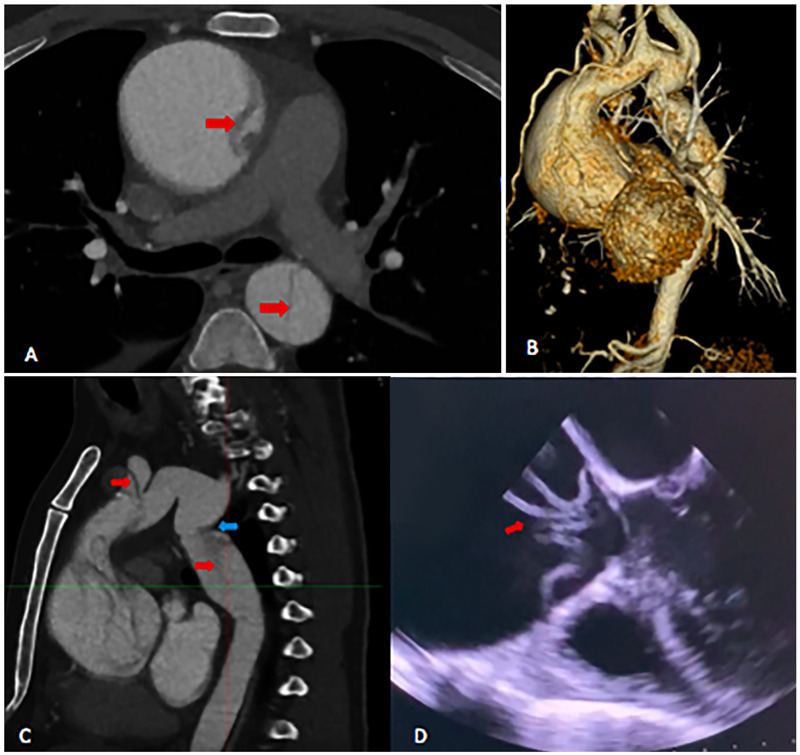 Acute Stanford type A aortic dissection associated with aortic coarctation repaired by Tirone E. David & debranching techniques with combined axillar and femoral perfusion: a case report.