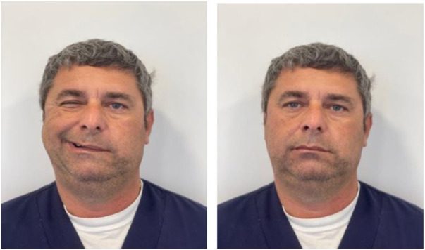[Bell's palsy following COVID-19 vaccination: A case report].