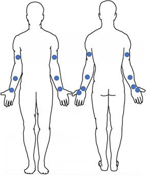 Measuring Biomechanical Properties Using a Noninvasive Myoton Device for Lymphedema Detection and Tracking: A Pilot Study.