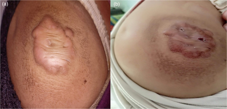 Evaluating serum level of thymidylate synthase in post burn keloid patients before and after intralesional injection of 5-fluorouracil.