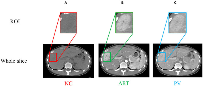 Phase Attention Model for Prediction of Early Recurrence of Hepatocellular Carcinoma With Multi-Phase CT Images and Clinical Data.