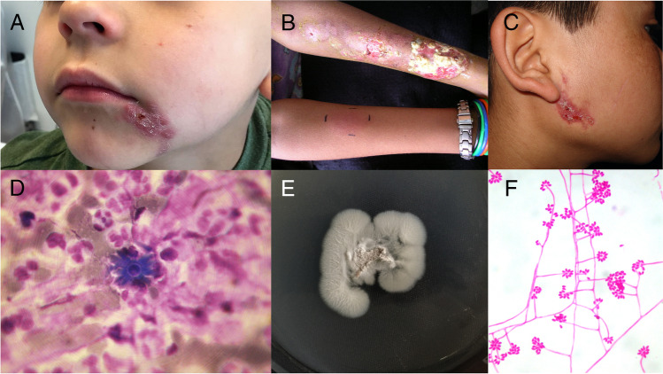 Sporotrichosis in Children: Case series and Narrative Review.