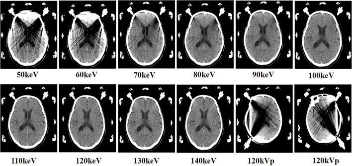 Comparison of Image Quality and Radiation Dose Between Single-Energy and Dual-Energy Images for the Brain With Stereotactic Frames on Dual-Energy Cerebral CT.