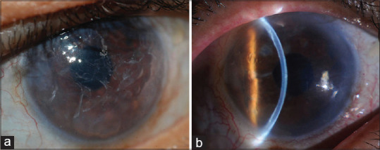 Toxic Keratopathy Induced by Self-Application of Seawater.