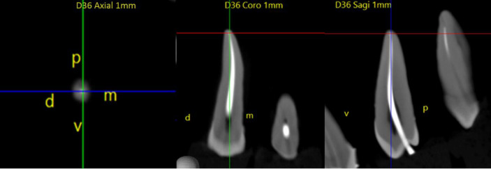 Adaptation of a Single-Cone in Prepared Teeth with Two Reciprocating Systems.