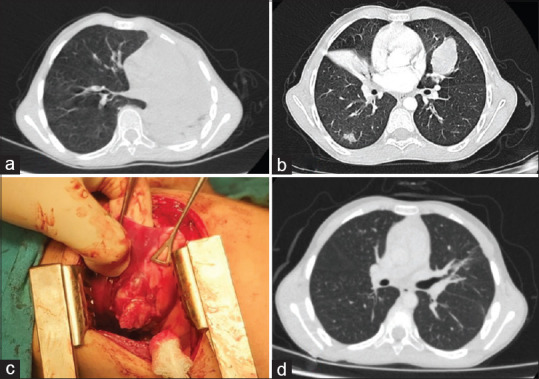 Surgical treatment outcomes of pulmonary inflammatory myofibroblastic tumors.