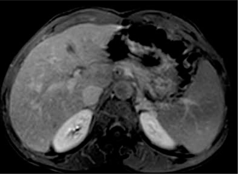 The value of the apparent diffusion coefficient value in the Liver Imaging Reporting and Data System (LI-RADS) version 2018.