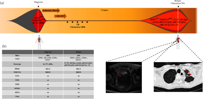 Relapse of <i>NPM1</i>-Mutated AML with Extramedullary Manifestation 17 Years after Allogeneic Hematopoietic Stem Cell Transplantation.