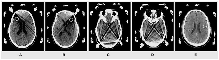 Comparison of Image Quality and Radiation Dose Between Single-Energy and Dual-Energy Images for the Brain With Stereotactic Frames on Dual-Energy Cerebral CT.