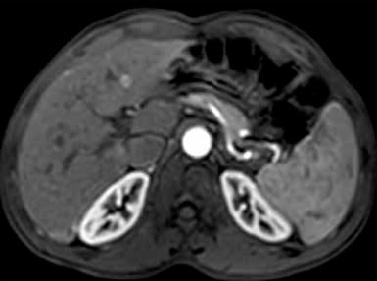 The value of the apparent diffusion coefficient value in the Liver Imaging Reporting and Data System (LI-RADS) version 2018.