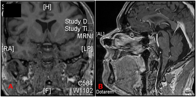 Potential pitfalls in diagnosis of immunotherapy-induced hypothalamic-pituitary-adrenal axis abnormalities: a clinical case.