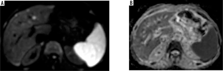 The value of the apparent diffusion coefficient value in the Liver Imaging Reporting and Data System (LI-RADS) version 2018.