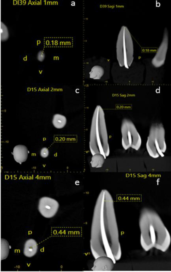 Adaptation of a Single-Cone in Prepared Teeth with Two Reciprocating Systems.