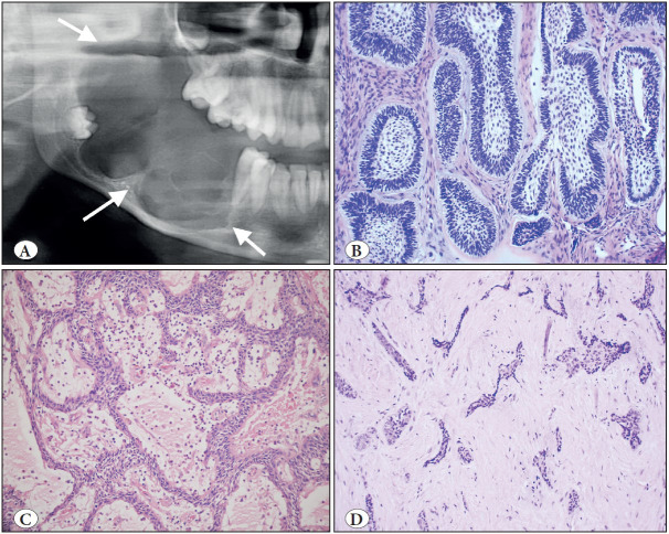 The World Health Organization Classification of Odontogenic Lesions: A Summary of the Changes of the 2022 (5th) Edition.