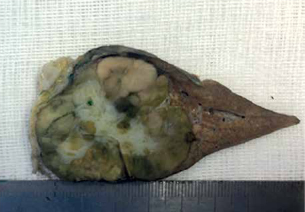 Fibrolamellar hepatocellular carcinoma presenting with early recurrent thrombosis.