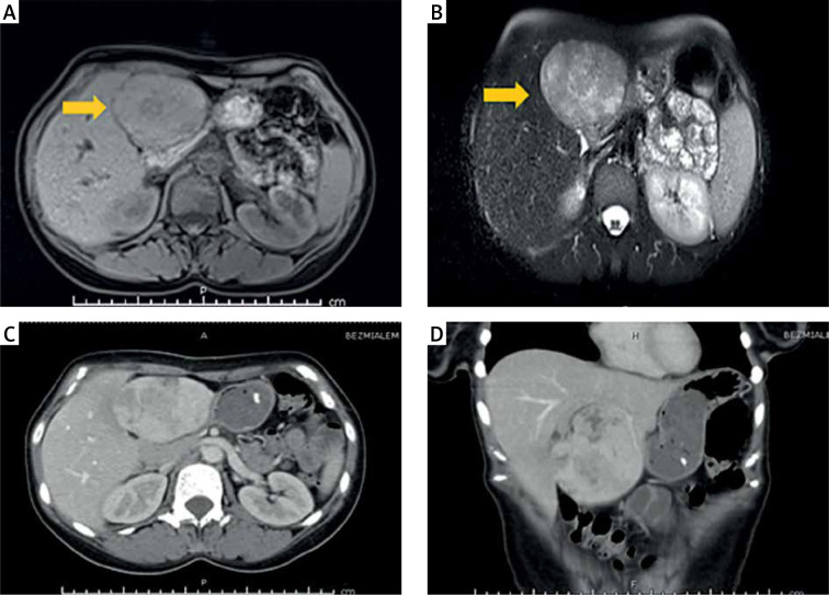 Fibrolamellar hepatocellular carcinoma presenting with early recurrent thrombosis.