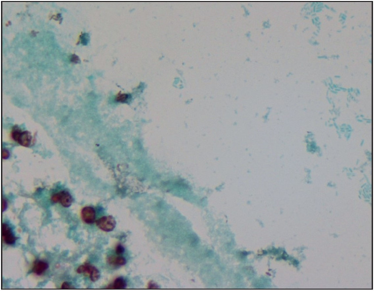 Granulomatous Mastitis: A Clinical and Diagnostic Dilemma.