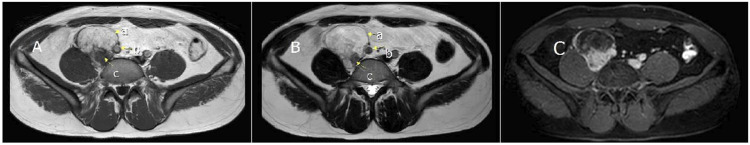 Pelvic retroperitoneal pleomorphic hyalinizing angiectatic tumor: A case report and review of literature.