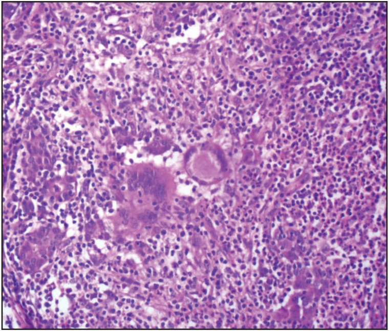 Granulomatous Mastitis: A Clinical and Diagnostic Dilemma.