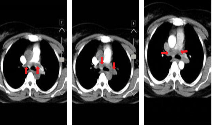 Lower limb arterial thrombosis followed by sub-massive pulmonary thromboembolism after Sinopharm BBIBP-CorV COVID-19 vaccination.