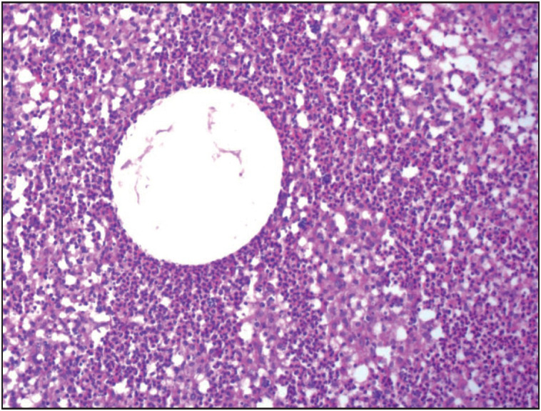 Granulomatous Mastitis: A Clinical and Diagnostic Dilemma.