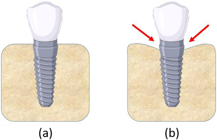 Effect of Bone Remodeling on Dental Implant Fatigue Limit Predicted Using 3D Finite Element Analysis.