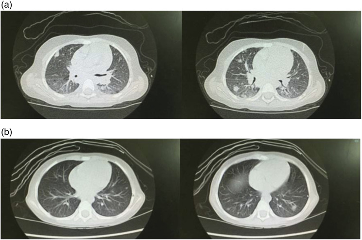 Various phenotypes of <i>LRBA</i> gene with compound heterozygous variation: A case series report of pediatric cytopenia patients.