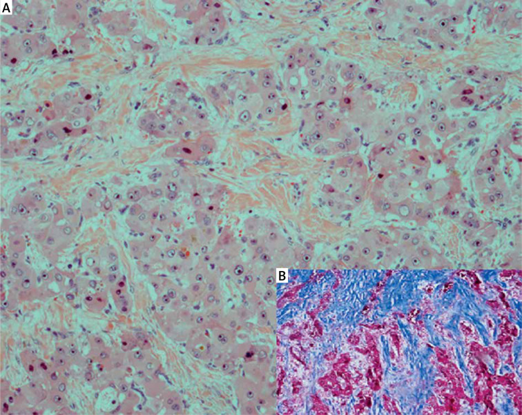 Fibrolamellar hepatocellular carcinoma presenting with early recurrent thrombosis.