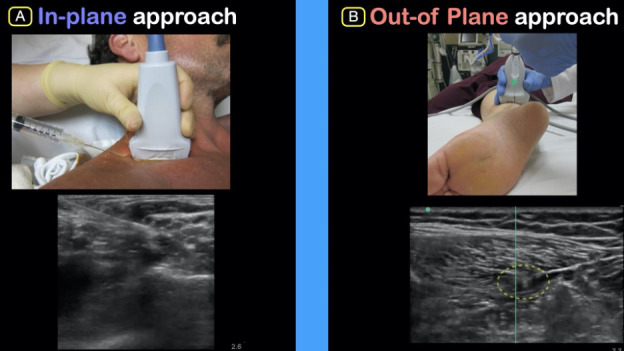 Ultrasound-Guided Nerve Blocks: Suggested Procedural Guidelines for Emergency Physicians.