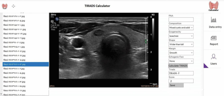 Observation Variation in Ultrasonography Assessment of Thyroid Nodules.