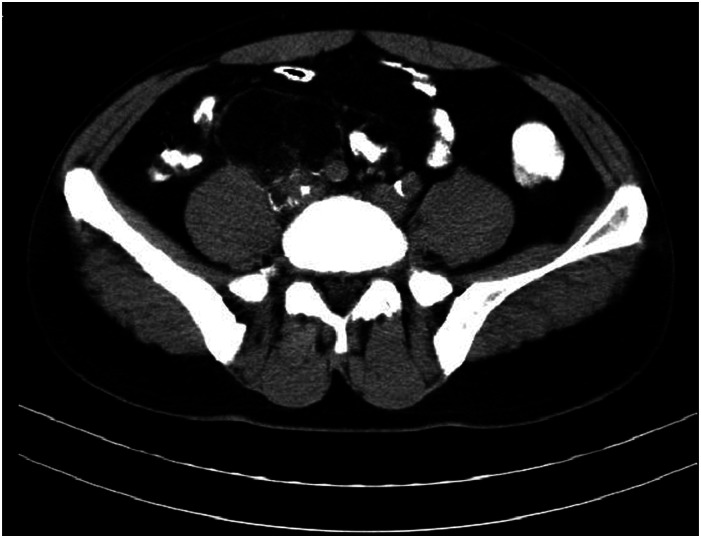 Pelvic retroperitoneal pleomorphic hyalinizing angiectatic tumor: A case report and review of literature.