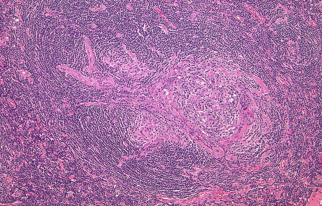 Idiopathic plasmacytic lymphadenopathy: A conceptual history along with a translation of the original Japanese article published in 1980.