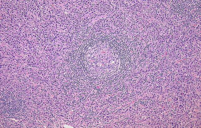 Idiopathic plasmacytic lymphadenopathy: A conceptual history along with a translation of the original Japanese article published in 1980.